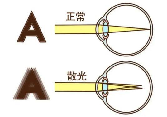 散光≠近视！散光到底是啥？