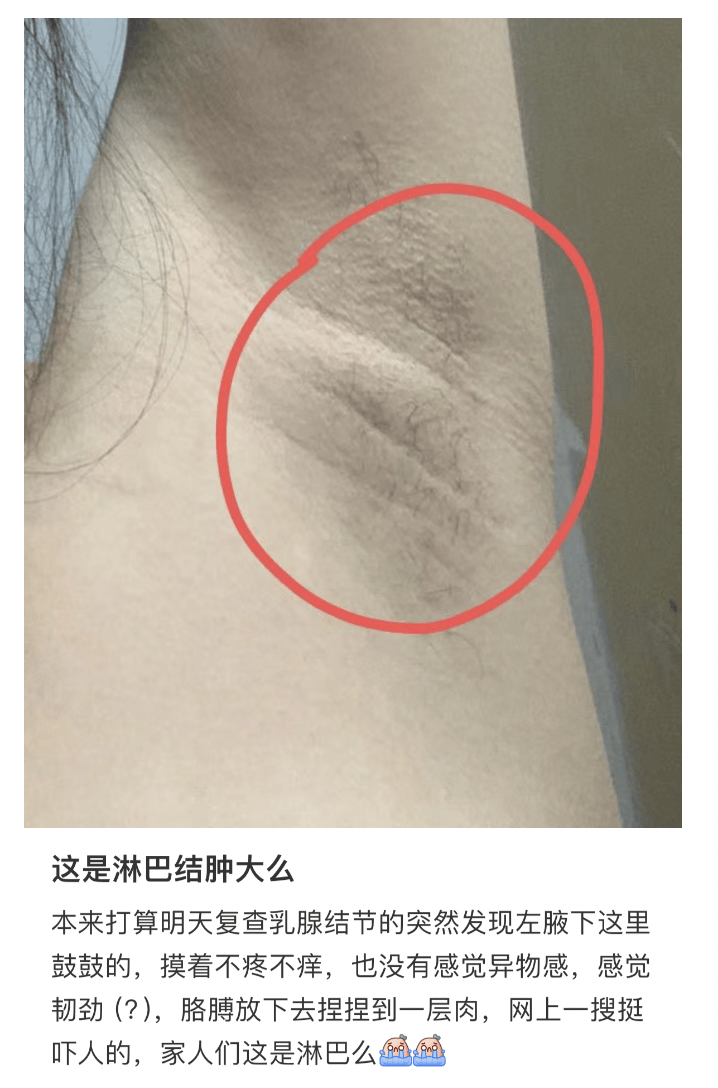 腋窝下的疙瘩，到底是个啥？