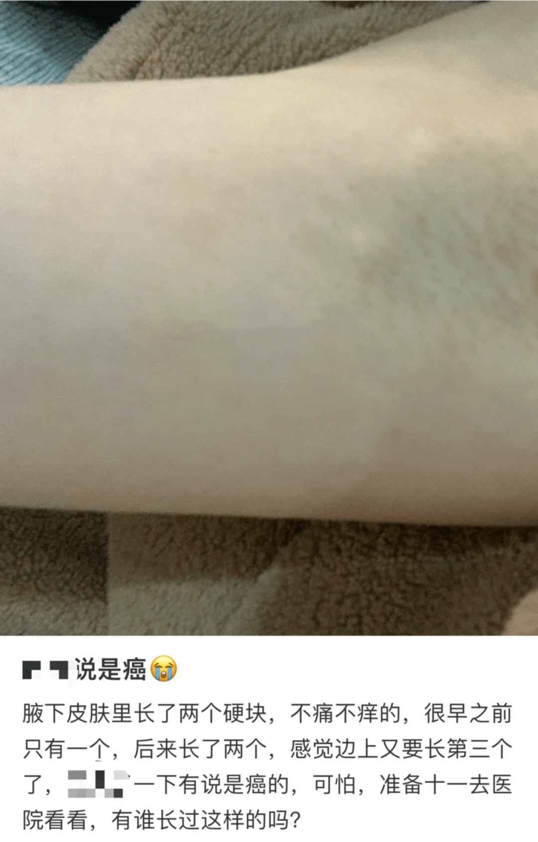 腋窝下的疙瘩，到底是个啥？