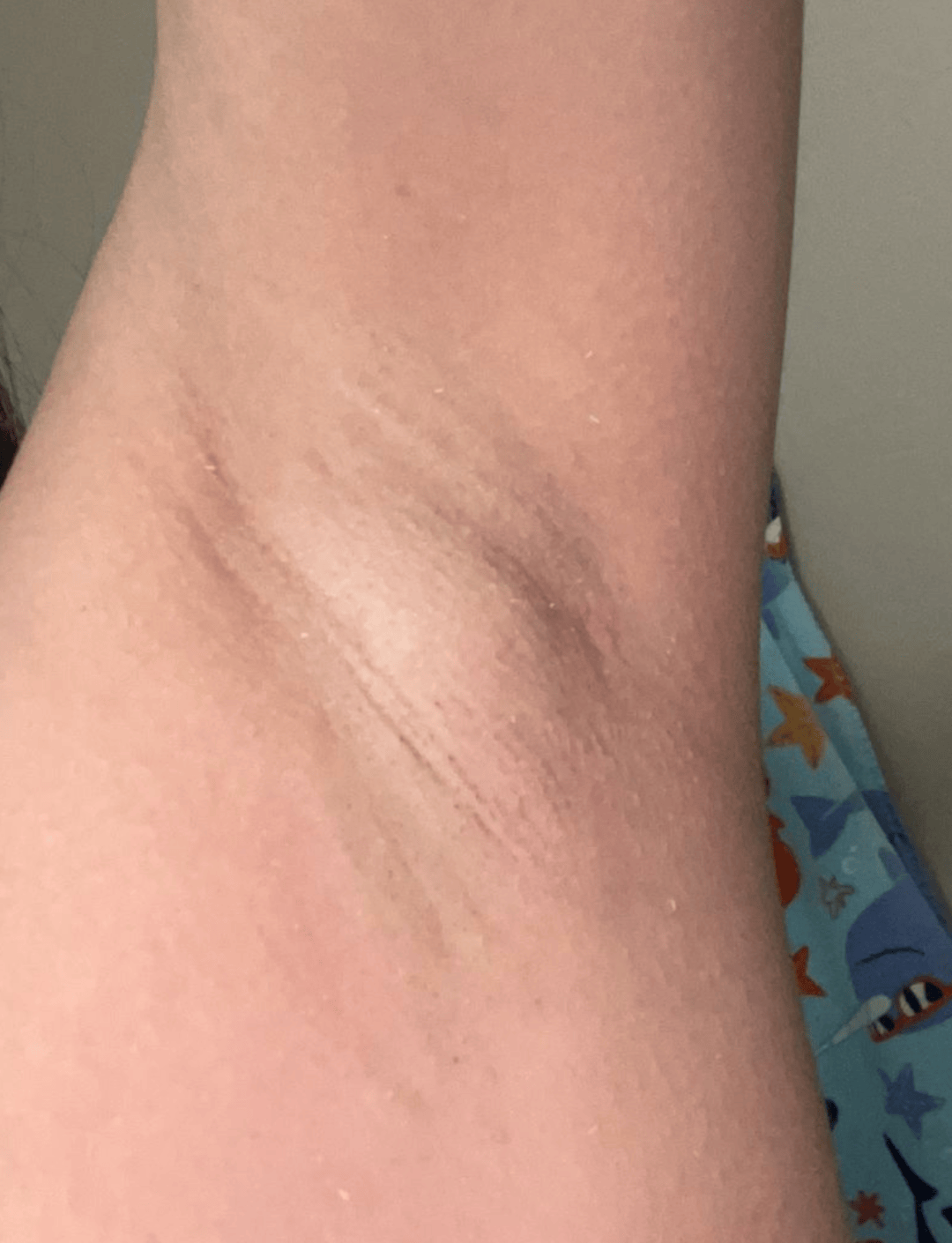 腋窝下的疙瘩，到底是个啥？
